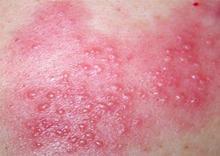 单纯性疱疹的症状表现有哪些？