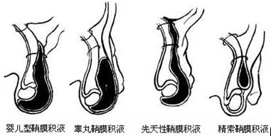 最新技术——腹腔镜微创手术治疗睾丸鞘膜积液